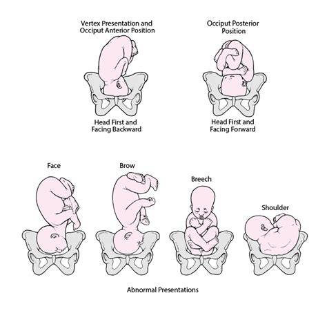 diagram-showing fetal presentations (cranial, breech, transverse)