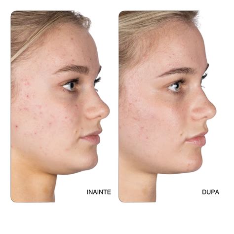 Tratament pentru petele pigmentare în sarcină