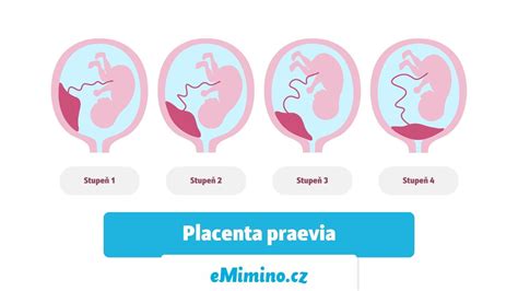 Infografic: Tipuri de placenta praevia si situatie in sarcina
