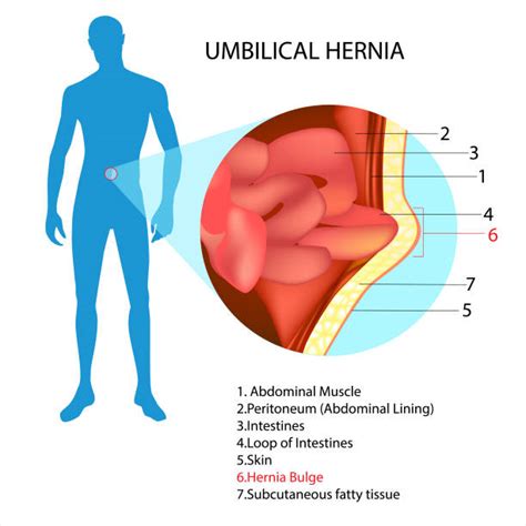 Schemă anatomică a herniei ombilicale la nou-născut