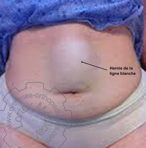 Tabel comparativ: Hernie ombilicală la copii vs. adulți