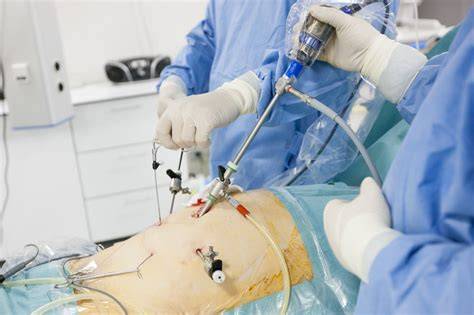 Grafice: recuperare postoperatorie dupa apendicectomie laparoscopica vs deschisa