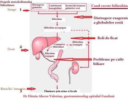 Infografic: Tipuri de icter - prehepatic, hepatic, posthepatic