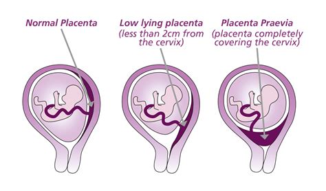 schema placenta praevia vs placenta posterioara