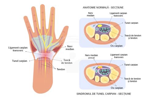 Diagrame de comprimare nervoasă la nivelul membrelor superioare (tunel carpian, cot)