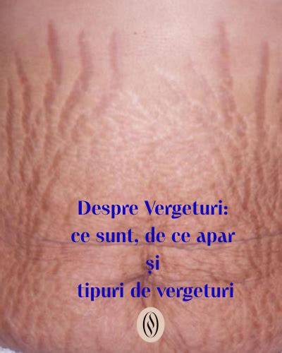 Vergeturi la sân în sarcină: exemple vizuale