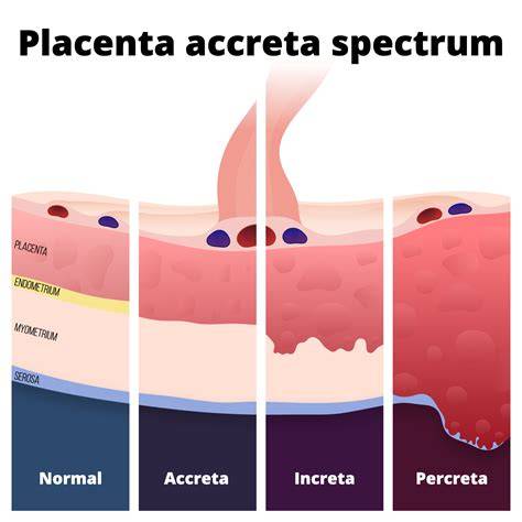 Placenta previa si placenta accreta: diagrame despre localizarea placentei si impactul asupra sarcinii