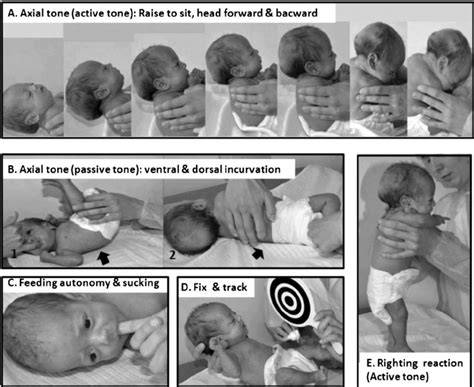 Diagramă de screening neurodezvoltativ la prematuri (BINS, Bayley, Amiel-Tison)