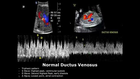 Diagrama flux Doppler la nivelul ductus venosus
