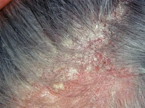 Comparație între șampoane pentru dermatita seboreică