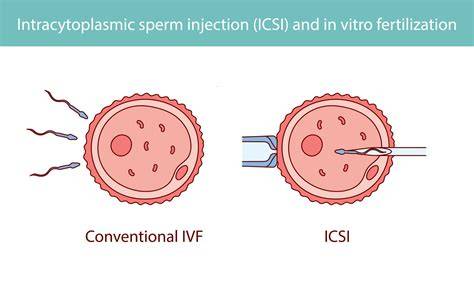 Diagramă: fluxul procesului de reproducere umană asistată (IUI, FIV, ICSI)