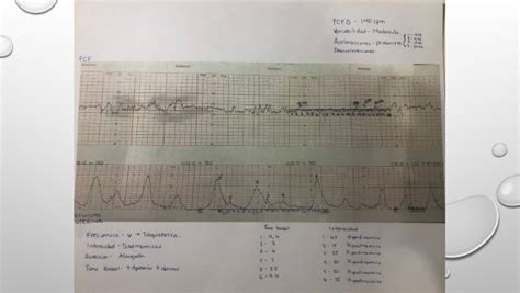 Cardiotocograma non-stres NST: procedură și interpretare