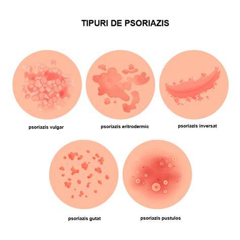Infografic: principalele tipuri de iritații ale pielii la bebeluși, cauze și soluții
