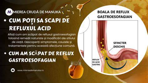 Infografie: mecanismele refluxului gastroesofagian în sarcină