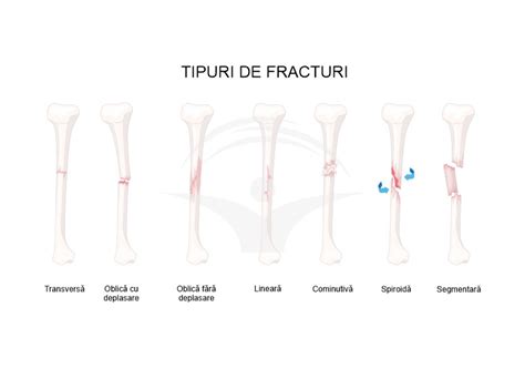 Infografic: Retea de fracturi osoase si optiuni de tratament
