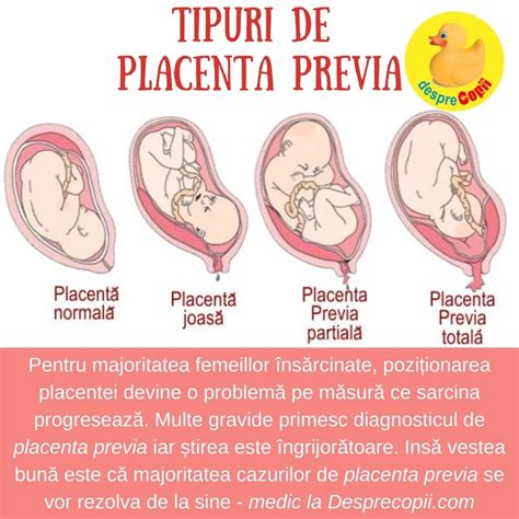 Infografic: factori de risc pentru placenta previa și placenta accreta în cezariane multiple