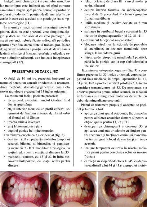Infografic: Efectele suzetei asupra arcadelor dentare, deschidere palat, protruzie