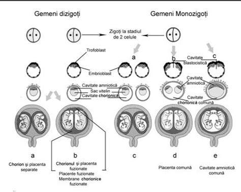 Infografice despre gemeni monozigoți vs heterozigoți: placente, saci amniotici, tipuri de gemeni