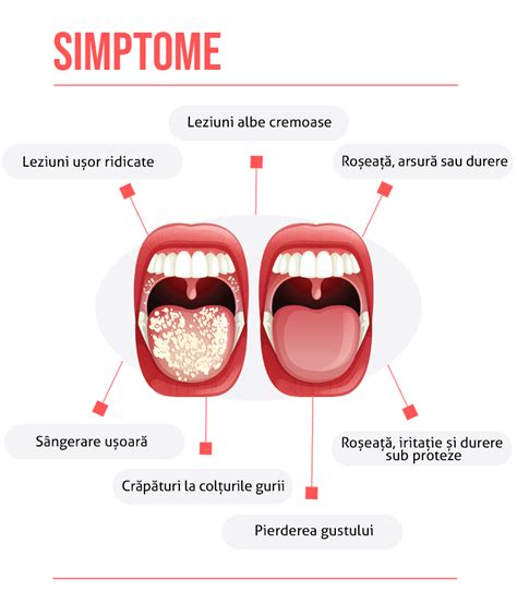 Diagrama tipurilor de afte bucale: afte, candidoza bucala, stomatite
