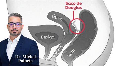 Diagramă a localizărilor endometriozei, inclusiv în sacul Douglas