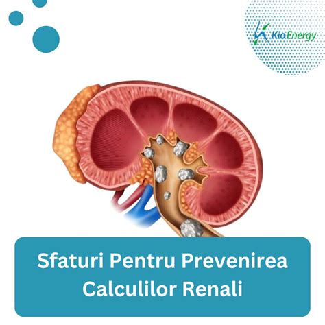 Diagramă a tractului urinar și localizarea calculilor renali