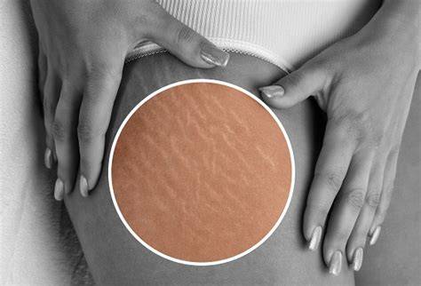 Imagine infografic despre hidratare si preventie vergeturi in sarcina