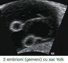 Imagine: Ecografie timpurie - vizualizarea sacului gestational si a batailor cardiace