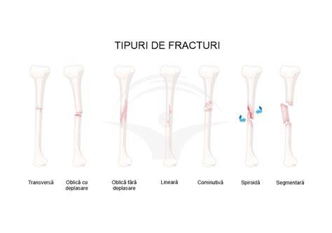 Infografic: etapele vindecarii osoase si abordarea chirurgicala in fracturi complicate