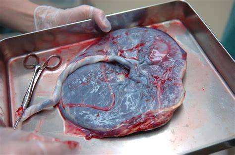 Diagrame despre riscurile aferente cezarianelor repetate: aderențe, placenta, incizii