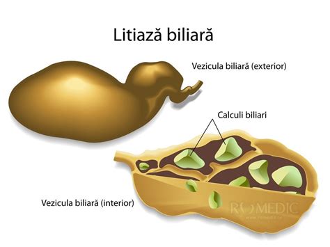 Infografica: Fiziologia vezicii biliare si flagelul colicii biliare