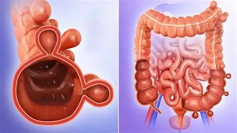 Infografic: Diverticuloza colonică sigmoid - distribuție, simptome și tratament