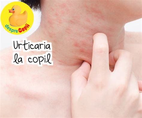 Ghid vizual: simptome si tipuri de urticarie la copii