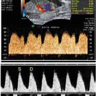 Diagrama Doppler in RCIU: fluxuri normala vs. patologic