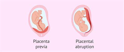 Diagrama cauze sangerare in sarcina - implantare, placenta previa, abruptio placentae