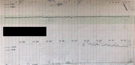 Monitorizare cardiotocografică în travaliu