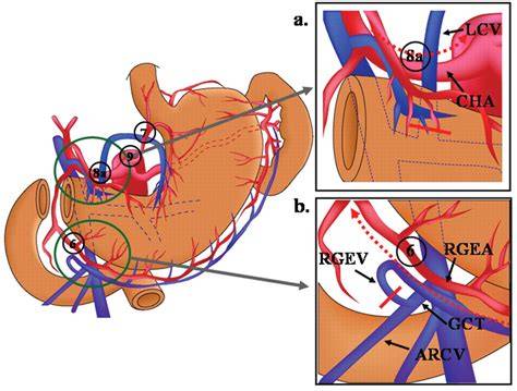 schemă 3D a gastrocolic trunk