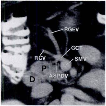 afișaj CT/3D a varianțelor gastrocolic trunk
