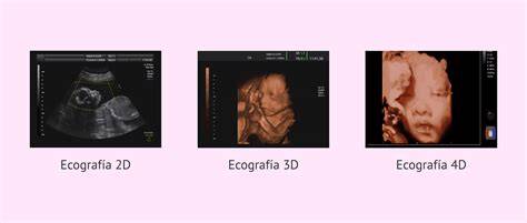 Infografic: Tipuri de ecografii (2D, 3D, 4D) si etapele morfologice ale sarcinii