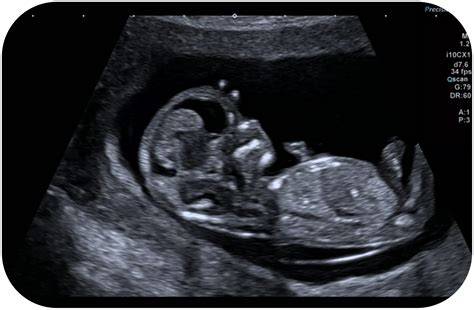 ecografie morfologica - aflarea sexului