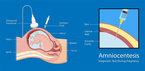 Infografic: CVS vs Amniocenteza - momentele intervenției și rata de diagnostic