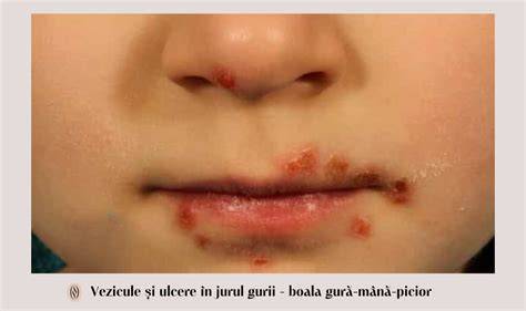 Imagini Dermnetnz.org despre boala gură-mână-picior