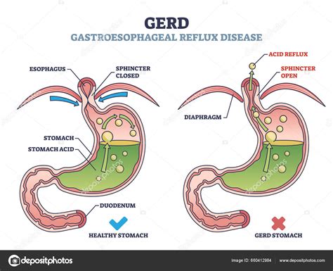 schema-reflux-gastroesofagian-bebelus