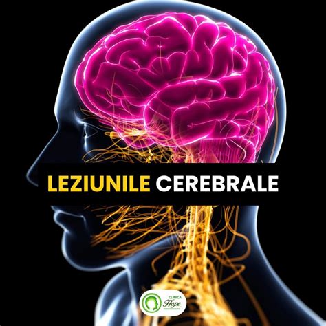 Infografic: mecanismul leziunilor cerebrale in sindromul zgaltairii la sugar