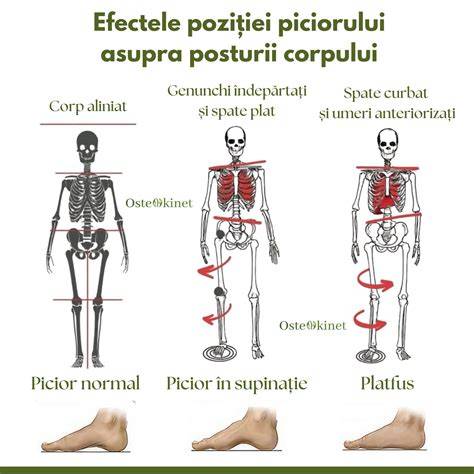 Diagramă a aliniamentului piciorului în deptul normal și patologic