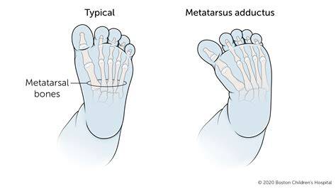 Infografic: cauzele mersului în interior la copii (metatarsus adductus, torsiune tibială internă, anteversiunea femurală)