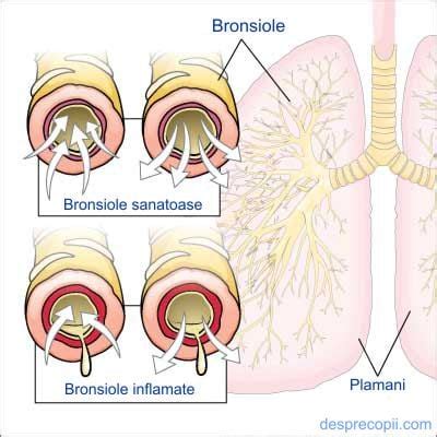 Diagrama schema tratament bronsiolita copii