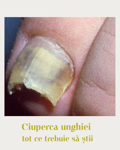 Diagrama: Drumul infecției fungice către unghie și imagini ale tratamentelor
