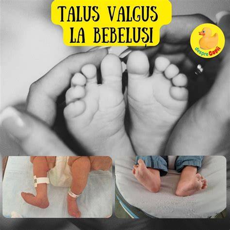 Imagineinfografic-talus-valgus-bebelusi