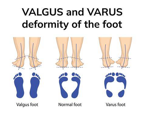 Infografic-exercitii-acasa-talus-valgus