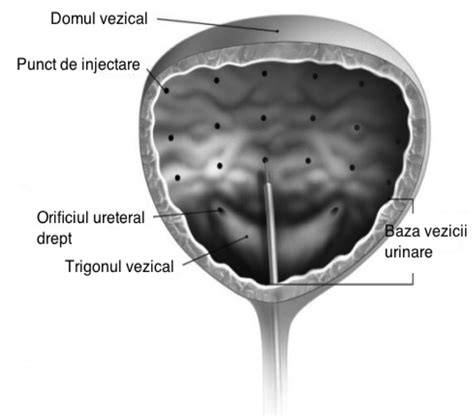 Diagramă: zone de injectare tipice pentru anestezie locală în ginecologie